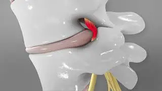 Así son las hernias discales