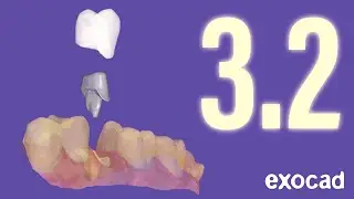 exocad 3.2 Elefsina - Les Points Forts en 1 MINUTE