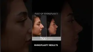 Before and after Rhinoplasty - Dr Guncel Ozturk 