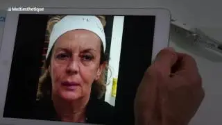 Acide hyaluronique : un coup de jeune à tous les niveaux – Dr Uberto Giovannini