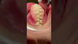 Periodontal health around BOPT crown 