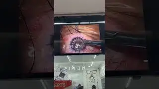 Unnerving Eye Operation Video