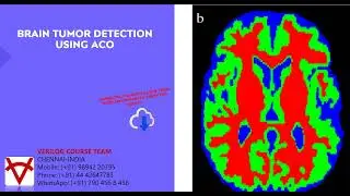 OPEN SOURCE CODE-BRAIN TUMOR DETECTION USING ACO