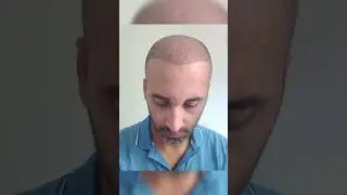 hair Transplantation/Haare Transplantation/ 4 months result