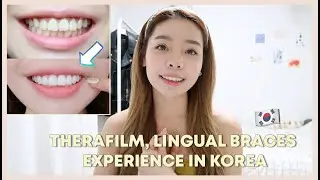 MY TEETH LAMINATE, BRACES EXPERIENCE IN KOREA 😬 무삭제 라미네이트, 치아교정 2D CLINIC | Erna Limdaugh