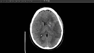 Stroke and Seizures