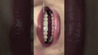 Винир