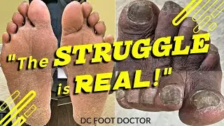 The Struggle is Real:  Struggling with Foot Care and Underlying Health Issues; Toenails and Calluses