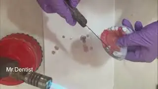 Temporary Partial Denture   !!!!!