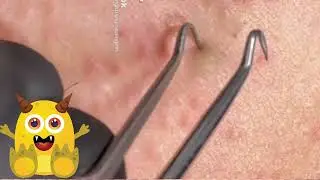 Blackheads and Restmore!