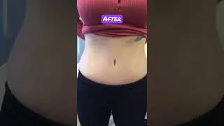 Tummy Tuck Before and After on Mom of Triplets! 