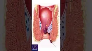 Hemorrhoid Laser Surgery Treatment 