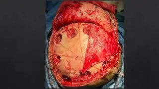 Falks-sinus o'sma (meningioma).      #опухоль #tumors