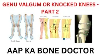 GENU VALGUM  OR KNOCKED KNEES -  PART 2 - EPISODE 63