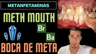 METH MOUTH - BOCA DE METANFETAMINA o CRISTAL - Efectos secundarios del abuso de drogas