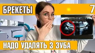 Путь к Брекетам | Надо удалять 3 зуба | Панорамный снимок зубов