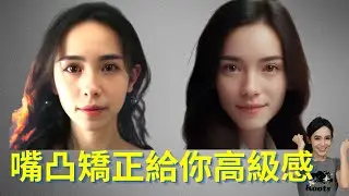 牙齒矯正拔牙加打骨釘能改多少嘴凸？嘴凸矯正會改變臉型？深咬打開方式如何影響臉型？骨性暴牙與齒性暴牙改嘴凸差異。有牙套臉怎麼回復？Braces for protrusion｜林榆芩醫師LinYuChin