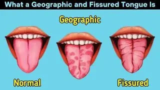 What a Geographic and Fissured Tongue Is | Health Video