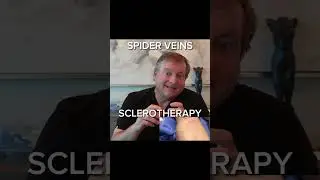 SCLEROTHERAPY - treatment for Spider Veins
