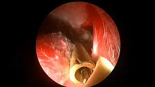 Coagulation Endoscopique Du Tunnel Parenchymateux Au Cours De La NLPC