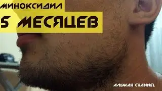 Миноксидил хочу бороду. 5 месяцев