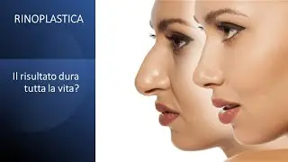 Rinoplastica, il risultato dura tutta la vita? || Dr Paolo Montemurro - Chirurgo Plastico