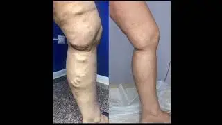 Флебологи из Махачкалы