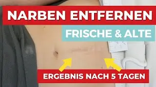 Narben entfernen - frische & Alte Narben - Das Ergebnis nach 5 Tagen