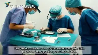 Calvitie: greffe de cheveux implant capillaire FUE à Paris