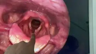 Vocal cord nodules, and vocal cord polyps are noncancerous growths or bumps, on your vocal cords.