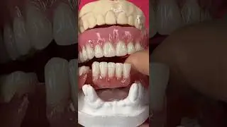 Denture vs Flexible partial