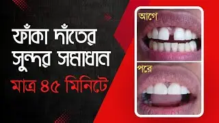 ফাঁকা দাঁতের সহজ ও সুন্দর সমাধান faka dater cikitsha || Diastema Tooth @DentalHealthTips