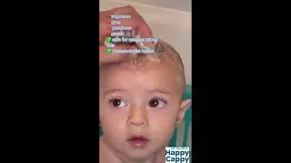 Momma Uses Happy Cappy Medicated Shampoo for Her Little One's Cradle Cap - Look at the Before/After!