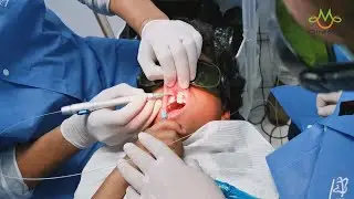 Berylas Dental Laser Treatment - Good Helper for Dentists