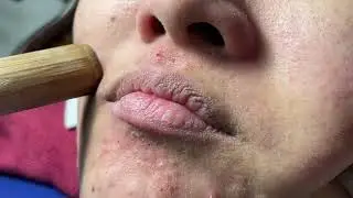 Make acne and roll bamboo tubes - Acne Treatments Mai Ngoc 💕💕💕
