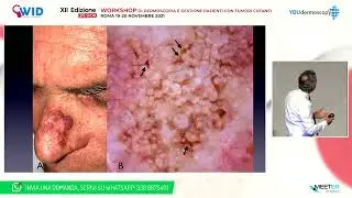 XII Worshop - G. Argenziano - Lesioni del volto: opzioni diagnostiche