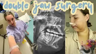 my double jaw surgery experience (pre-op, surgery day, and 3 months of recovery!)
