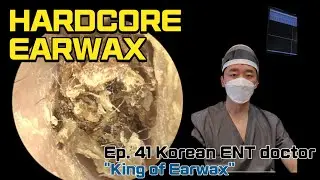 귀지형의 Ep. 41 귀지제거 (Korean otolaryngologist “King of earwax” Ep. 41 earwax removal)