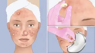 ASMR | Juicy Acne Popping & Cyst Draining