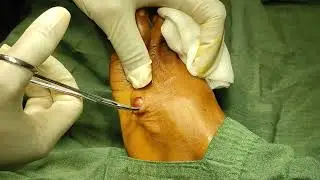 Ganglion Cyst Removal, Minor Surgery, #Ayurvedatech #ganglioncyst