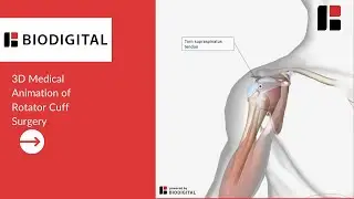 3D Medical Animation of a Rotator Cuff Surgery