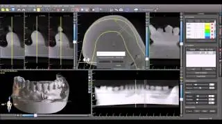 Creatig an STL from a Stone Model with CBCT