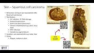 Skin: Squamous cell carcinoma (Gross pathology)