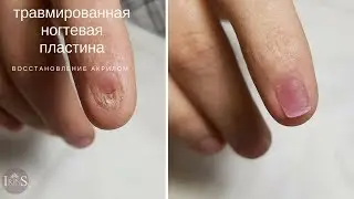 Восстановление травмированного ногтя