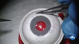SimulEYE Iridodialysis Repair YouTube