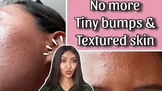 How to get rid of Tiny bumps & Textured skin 😱| 100% Solution on tiny bumps & Textured skin ✨ |