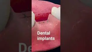 Dental Implants Treatments