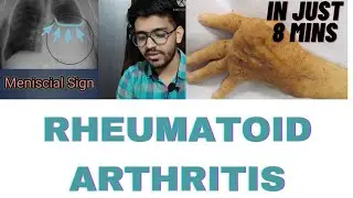 RHEUMATOID ARTHRITIS #medico  #rheumatology #arthritis