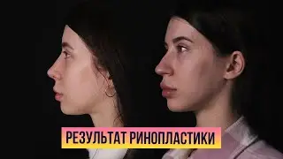 Результат ринопластики доктора Жасулана Ахметалиевича