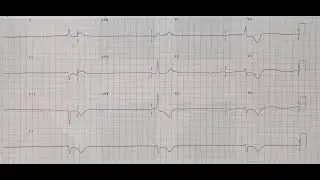 5 aralık 2023 vize oncesi son ders Vizedeki ekg ler